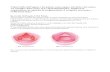 L’Ipertrofia dell’ugola e del palato causa apnee ...fabriziosalvinelli.it/wp-content/uploads/2013/09/UVULOPALATO... · Ipertrofia tonsillare Preoperatorio Intraoperatorio Postoperatorio
