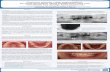 Posterior alveolar ridge augmentation: An onlay technique ...abstracts.ects-ibms2015.org/ectsibms/0001/eposters/ectsibms0001p40... · Posterior alveolar ridge augmentation: An onlay