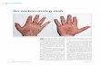 An embarrassing rash - prescriber.co.uk · imumab, etanercept (Enbrel), ustek - inumab (Stelara) and infliximab (Remicade) are used for severe or resist-ant forms of psoriasis and