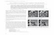 Role of Balloon Sinuplasty in the Treatment of Frontal ...applications.emro.who.int/imemrf/Bahrain_Med_Bull/... · frontal sinusitis was confirmed, with minimal involvement of the