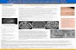 Kongenitale Facialisparese und „neurogener“ Fuß ... · über linken unterem Abdomen und lumbal median (Abb. 3). Cerebrales und spinales MRT: Bilaterale Akustikusneurinome sowie
