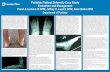 Pediatric Flatfoot Deformity Case Study Evaluation …...Pediatric Flatfoot Deformity Case Study Evaluation and Management Frank A Luckino III DPM, Jeffrey C. Lupica DPM, Allan Boike