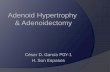 Adenoid Hypertrophy & Adenoidectomy · Lymphatic structure; part of the Waldeyer ring Located in the roof and posterior wall of the nasopharynx. Shaped as a pyramid Base at the junction