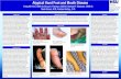 Atypical Hand Foot and Mouth Poster (MB Rev)secretions, as well as vesicle fluid. HFMD occurs worldwide, typically in children and infants younger than 7 years of age during the Summer