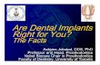 are dental implants right for you - University of Toronto · 2008-11-12 · Are Dental Implants Right for You? The Facts AsbjørnJokstad, DDS, PhD ... substitutes for the roots of