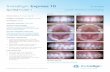 Invisalign Express 10 - Amazon S3 · 2015-08-31 · Invisalign ® Express 10 Spotlight Case 2 Spacing PATIENT PROFILE: Female, Age 19 NUMBER OF ALIGNERS: 10 upper/10 lower REFINEMENTS: