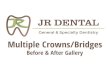 Before After - JR Dental Care Jacksonville · Before After Lab. Crowns and Bridges (Patient 6) Before After Crowns(Patient 1) Before After Crown (Patient 2) JR DENTAL General & Specialty