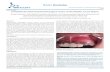 BAOJ Dentistry - Bio Accent › dentistry › dentistry08.pdf · Periapical and panoramic radiographs showed ... BAOJ Dentistry, ... pericoronal radiolucency with or without radiopacities