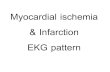 Myocardial ischemia & Infarction EKG pattern · Myocardial ischemia & Infarction EKG pattern Author: pikul Created Date: 5/7/2011 6:52:08 AM ...