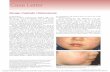 Benign Cephalic Histiocytosis - Amazon Web Services...Benign cephalic histiocytosis is a rare form of cutaneous histiocytosis in young children. It presents as a papular eruption on