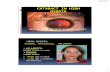 CATARACT IN HIGH MYOPIA - rio-conference.com · 2/26/2017 3 CATARACT IN HIGH MYOPIA LENS OPACITY. HIGH MYOPIA IS KNOWN TO BE ASSOCIATED WITH CATARACT. Increases risk of posterior