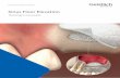 Sinus Floor Elevation...Sinus floor elevation vs. ridge preservation Sinus floor elevation is a complex surgical procedure, which causes severe discomfort for the patient. As an alternative,