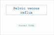 Pelvic venous reflux · reflux Vincent VIDAL. Definition PCS is a clinical syndrome with specific anatomic findings, - chronic pelvic pain - greater than 6 months duration - secondary