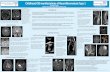 Childhood CNS manifestations of Neurofibromatosis Type 1 · Optic Nerve Gliomas Focal areas of high signal intensity (FASI) Plexiform Neurofibromas Sphenoid Wing Dysplasia Cerebral
