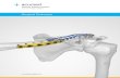 Acu-Sinch® Repair System - Acumed...procedure pack which includes an Acu-Sinch Drill, an Acu-Sinch Driver with a preassembled Anchor and Acumed FlexBraid® Suture, and two Suture