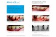 PERIODONTITIS CASE STUDY - EthOss Grow Stronger€¦ · Periodontitis in tooth 43 has caused bone loss Loosening of teeth: 3mm Pocket depth: 9mm Case performed by Dr Manuel Bras Da