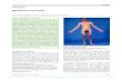 Klinefelter’s syndrome - University of Iceland · Klinefelter’s syndrome Klinefelter’s syndrome is the most common cause of testicular failure that results in impairments in