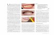 La mancha blanca presenta proceso de remineralización es ...€¦ · U na mancha blanca en los dientes es una lesión superﬁ - cial reversible que se presen-ta por la pérdida