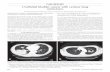 Urothelial bladder cancer with cavitary lung metastasesdownloads.hindawi.com/journals/crj/2011/273241.pdf · 2019-07-31 · Urothelial bladder cancer with cavitary lung metastases