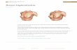 Breast Augmentation - drgelfant.com€¦ · Breast augmentation with implants has been done since the 1960s by plastic surgeons. The operation is far more sophisticated and successful