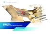 Thoracolumbar Solutions TriCor - Zimmer Biomet...TriCor Sacroiliac Joint Fusion System—Surgical Technique Guide 5 Anatomy Overview Structural Anatomy Sacroiliac Joint • Bicondylar