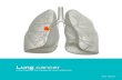 Lung cancer - Lungnakrabbamein.islungnakrabbamein.is/wp-content/uploads/2015/11/lung_cancer_infor… · 6 The area between the lungs is called the mediastinum, where lymph nodes can