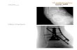 Pilon Fracture - Smith & Nephew...Pilon Fracture Case Study Dr. Reza Firoozabadi Case information The patient had a fall from a height and sustained a bimalleolar ankle fracture. She