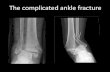 The complicated ankle fractureao-danmark.dk/.../02/5-The-complicated-ankle-fracture-LB.pdf2020/02/05  · The syndesmosis Malreduction • Weening B, Bhandari M: Predictors of functional