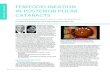 CATARACT SURGER FEMTODELINEATION IN POSTERIOR POLAR …crstoday.com/wp-content/themes/crst/assets/... · 36 CATARACT & REFRACTIVE SURGERY TODAY| MAY 2016 CATARACT SURGER A new laser
