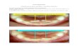 MALPOSITIONS (cf dysharmonie dento-maxillaire, cf ...from.scratch.free.fr/dentcyclopedie/pdf/malpositions.pdf · MALPOSITIONS (cf dysharmonie dento-maxillaire, cf positions dentaires)