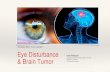 Surabaya Brain Tumor Update Eye Disturbance · 2019. 5. 30. · Departemen Ilmu Kesehatan Mata FK Unair/ RSUD Dr. Soetomo RS Premier Surabaya. Why Eye Examination Important PREDICTED