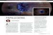 PAPILLEDEMA · 2020. 9. 1. · and often bilateral papilledema, as in this patient. n NICOLE HARRIS, OD n Optometrist, Associated Eye Care, Stillwater, Minnesota n nharris@associatedeyecare.com