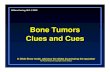 Bone Tumors Clues and CuesGeographic Bone Destruction ODestructive lesion with sharply defined border OImplies a less-aggressive, more slow-growing, benign process ONarrow transition