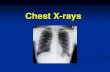 Chest X-rays...Chest X-ray Terms. Nodule – discrete opacity (usually small) Granuloma – nodule due to inflammation (e.g. past infection or foreign body/antigen); Can become fibrosed/calcified.