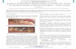 Indirect Biomimetic Restorations in Posterior Teeth - A ...