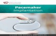 Pacemaker Implantation Patient guide