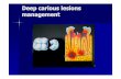 Management of deep carious lesions - UMP
