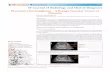 Placental Chorioangioma – A Benign Vascular Tumor of Placenta