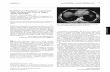 Budd-Chiari Syndrome and Portal Vein Thrombosis Due to Right Atrial Myxoma