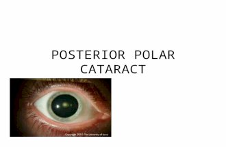 Posterior polar cataract