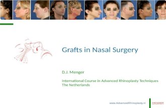 Grafts in Nasal Surgery - Advanced Rhinoplasty