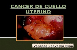 CANCER DE CUELLO UTERINO (CERVIX)