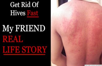 Get Rid Of Urticaria (Hives) Fast - My FRIEND REAL LIFE STORY