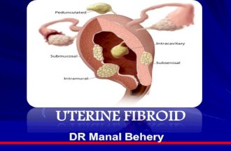 Fibroid for undergraduate