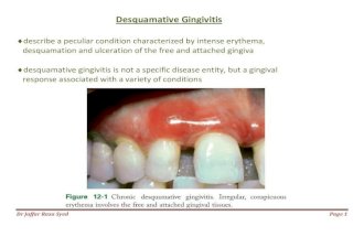 022.desquamative gingivitis