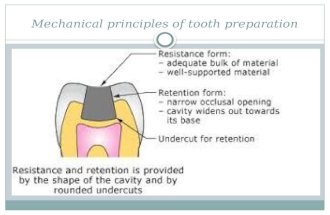 Mechanical principles of tooth preparation
