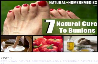 7 Incredible Natural Cures For Bunions