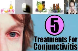 5 Treatments For Conjunctivitis