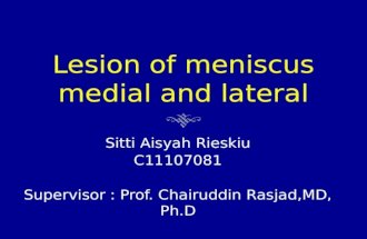 Lesion of Meniscus Medial and Lateral