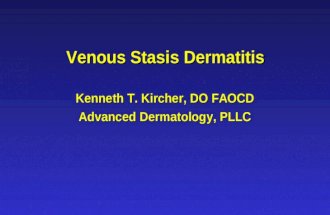 Venous Stasis Dermatitis Kenneth T. Kircher, DO FAOCD Advanced Dermatology, PLLC.